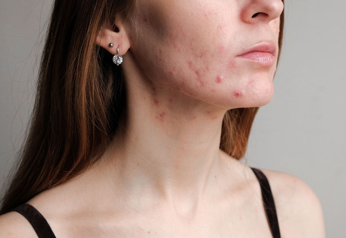 Acne Medical Skin Treatment Service Acne Medical Skin Treatment Service