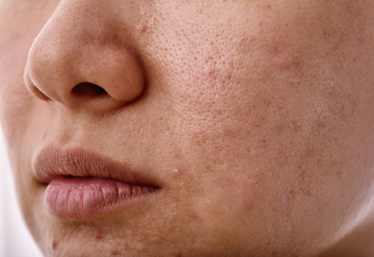 Congested Skin And Uneven Texture Congested Skin And Uneven Texture Medical Skin Treatment Service
