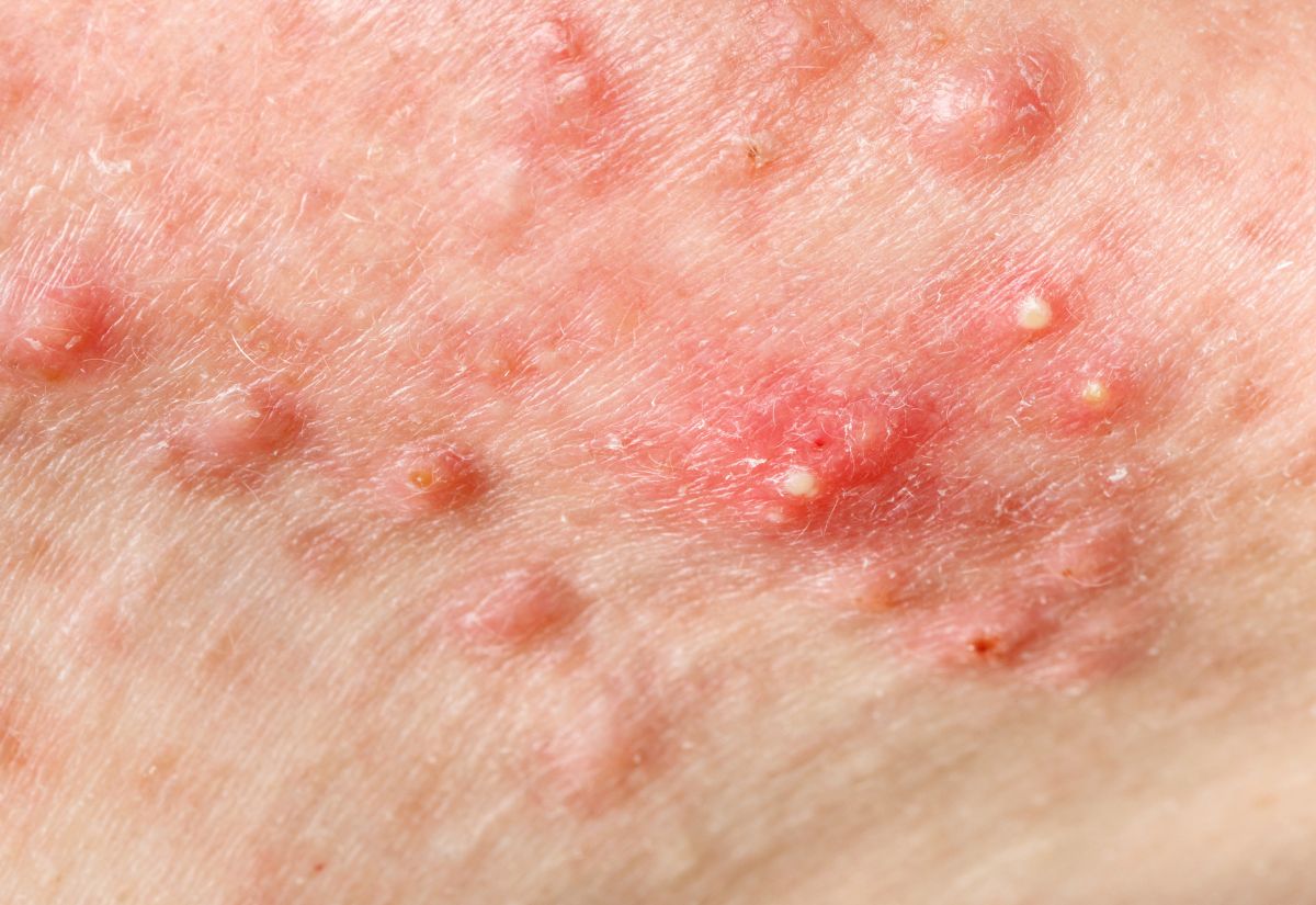 Cystic Acne Medical Skin Treatment Service Cystic Acne Medical Skin Treatment Service
