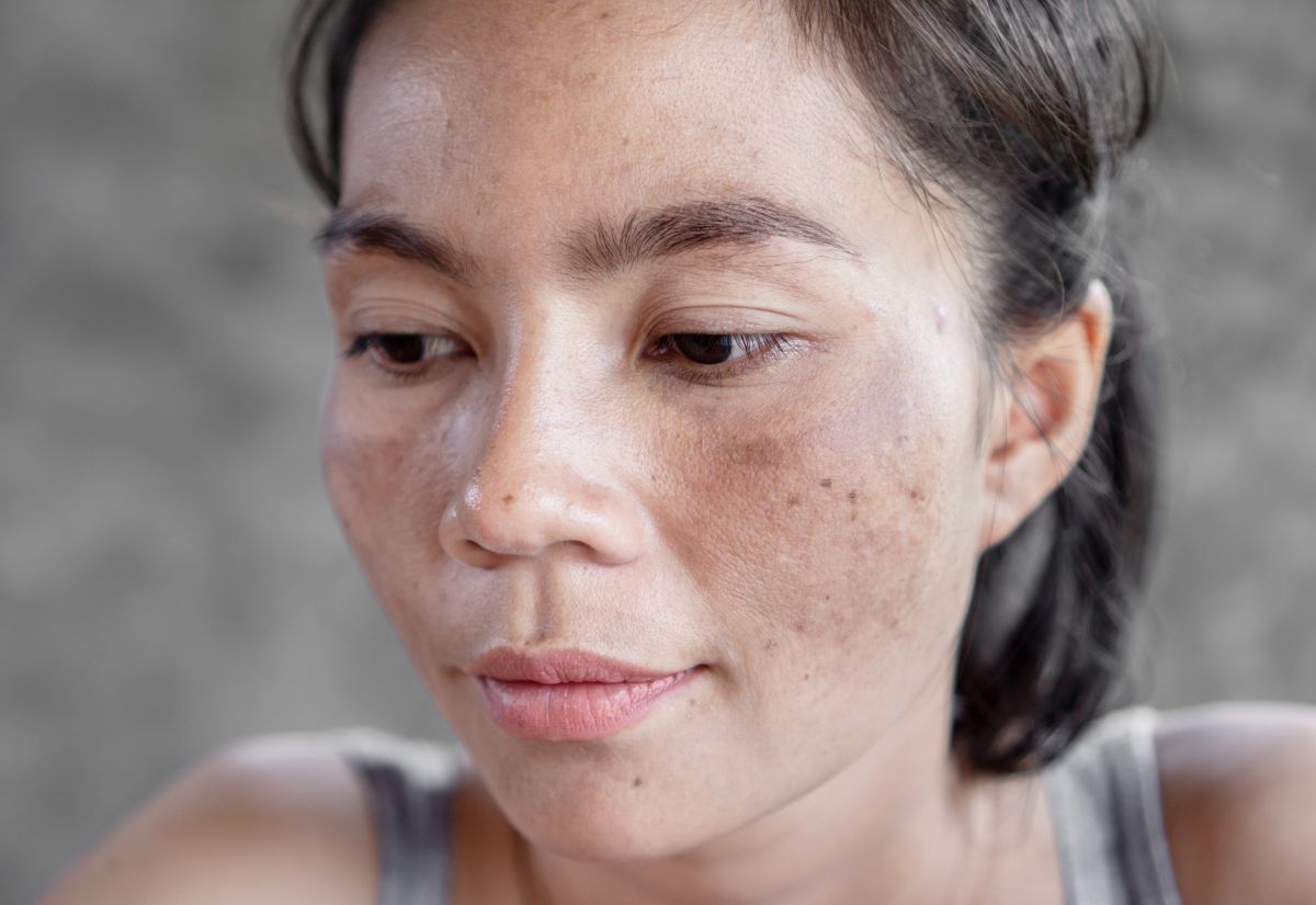 Melasma Medical Skin Treatment Service Melasma Medical Skin Treatment Service