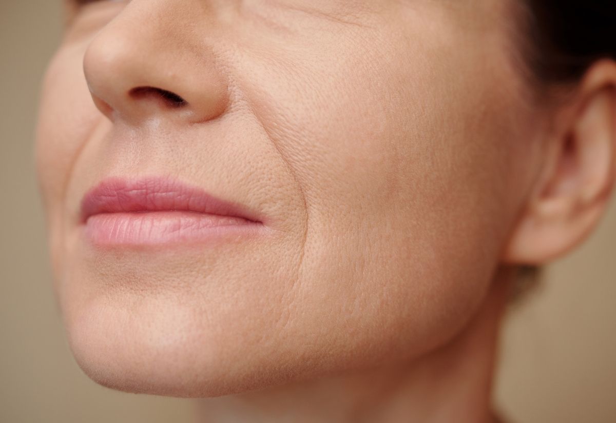Nasolabial Folds And Marionette Lines Dermal Fillers Nasolabial Folds And Marionette Lines Dermal Fillers
