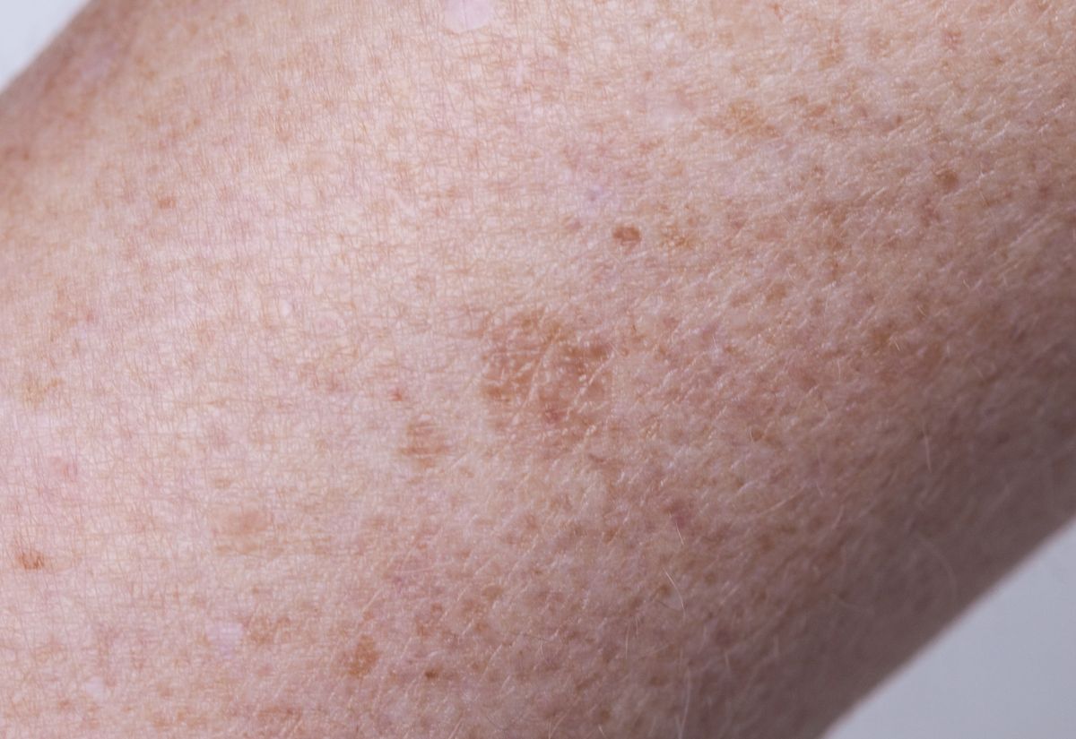 Post Acne And Hyperpigmentation Medical Skin Treatment Service Post Acne And Hyperpigmentation Medical Skin Treatment Service