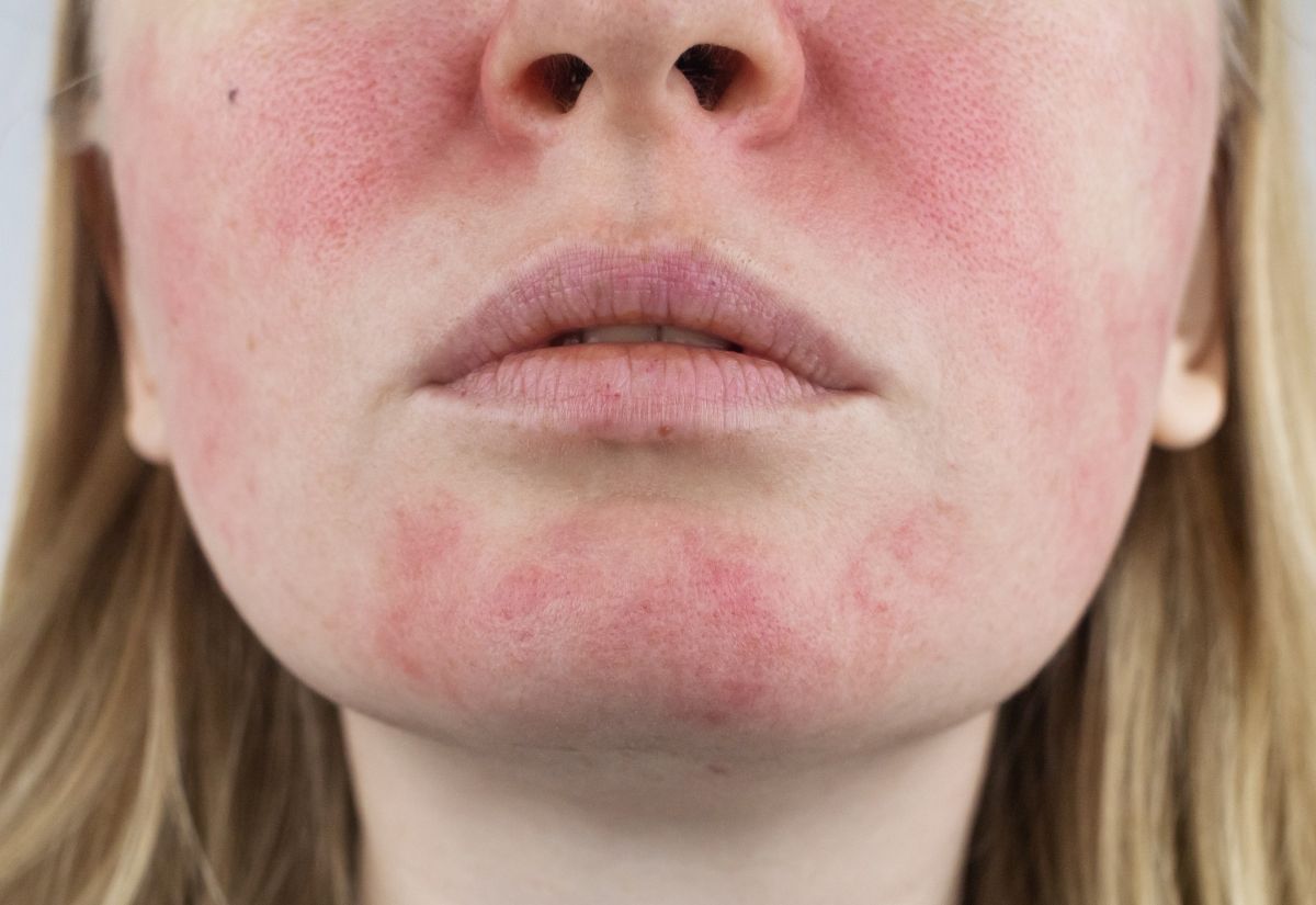 Rosacea And Facial Redness Medical Skin Treatment Service Rosacea And Facial Redness Medical Skin Treatment Service